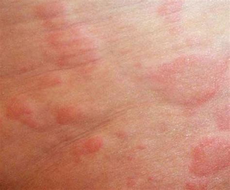 Itchy Skin Rash - Pictures, Causes, Symptoms, Treatment | HubPages