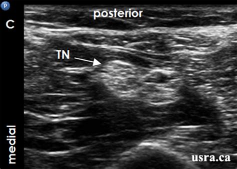 Popliteal Nerve Block Ultrasound