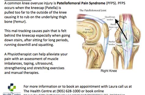 Patellofemoral Pain Syndrome (PFPS)