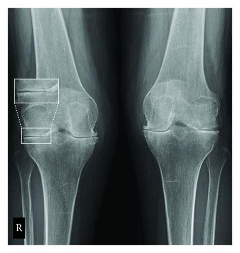 Rheumatoid Arthritis X Ray Knee