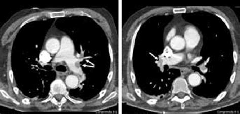 Capture image of a computed tomographic pulmonary angiography showing... | Download Scientific ...