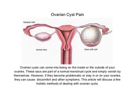 Ovarian Cyst Pain 20121224