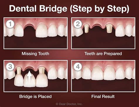 dental bridge - Dr. Ghorbani Aesthetic & Restorative specialist