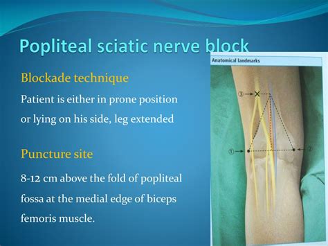 Popliteal Sciatic Nerve Block