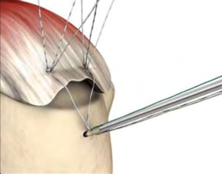 Why It's Important To Wear Your Sling After Rotator Cuff Surgery - Larson Sports and Orthopaedics