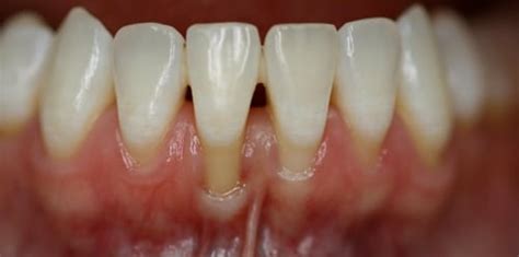 Receding Gums – Lane Ends Dental Practice – Preston