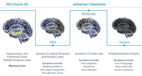 About AGB101 Development to Treat Mild Cognitive Impairment Due to Alzheimer's & Dementia ...