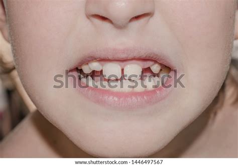 Primary Milk Teeth Fall Out Break Stock Photo 1446497567 | Shutterstock