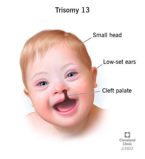 Trisomy Patau Syndrome | The Best Porn Website