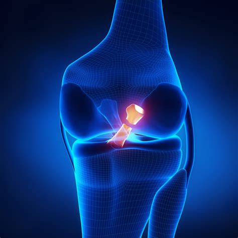 ACL Injury | Torn ACL | Knee Specialist | South Windsor, Enfield, Glastonbury CT