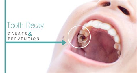 8 Major Causes Of Tooth Decay And How You Can Prevent Them - Photo #14398 - SpinSnap