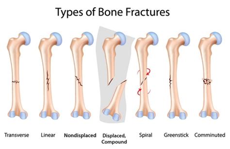 Femoral Fractures - Physiopedia, universal access to physiotherapy knowledge.