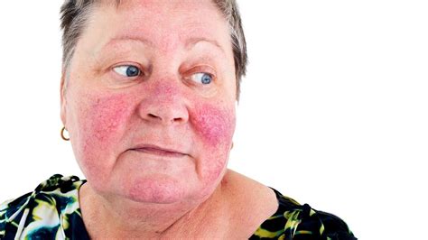 Most Common Skin Rashes In Adults