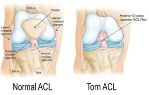 The 9 Best Exercises for ACL Injury Prevention in the Adolescent Female Athletes - Best Physical ...