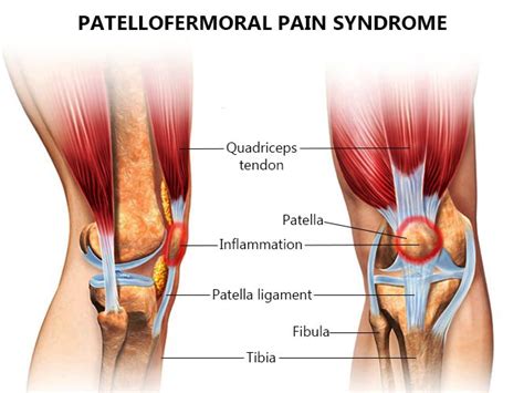 Patellofemoral Pain Syndrome Brace