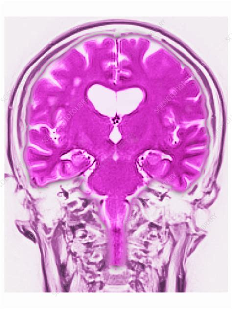 Brain MRI, White Matter Hyperintensities - Stock Image - C027/1268 - Science Photo Library