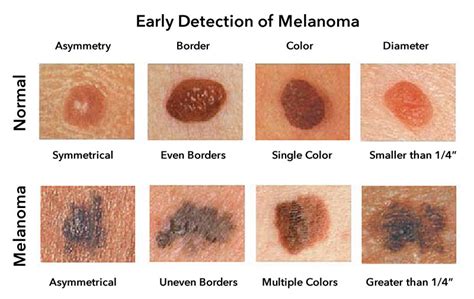 Melanoma Skin Cancer, Types, Stages, Grades, Signs, Symptoms, Risk Factors, Doctors & Specialist ...