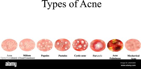 Types of Acne Skin inflammation. Pimples, boils, whitehead, closed comedones, papules, pustules ...