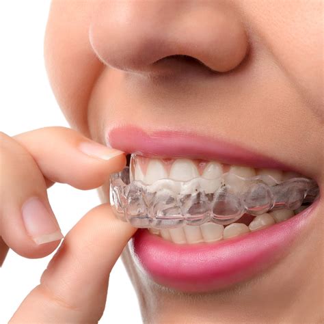 Invisible Braces - Invisalign & MTM brace systems