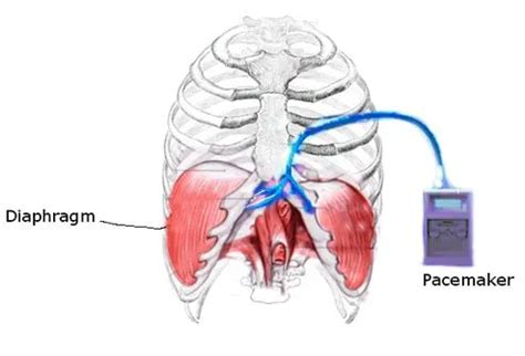 What Is a Diaphragm Pacing System?