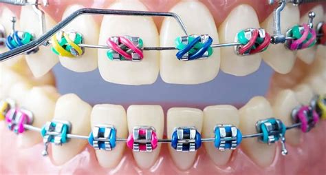 How to Choose the Best Braces Colors to Brighten Your Smile - World of Article