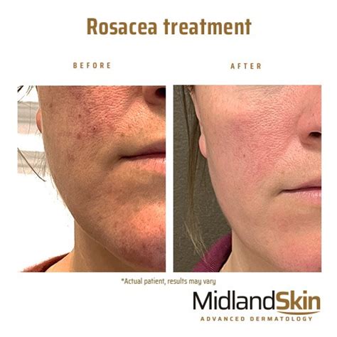 Rosacea, Redness and Flushing - Birmingham - Midland Skin