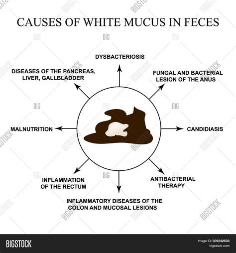 Mucus In Stool Human