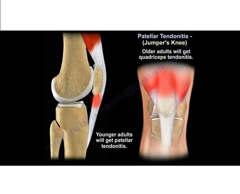 Patellar Tendinitis-Jumper’s Knee — OrthopaedicPrinciples.com