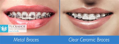 Difference Between Metal Braces and Clear, Ceramic Braces