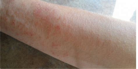 Do you know, yeast overgrowth can cause this Itchy rash?