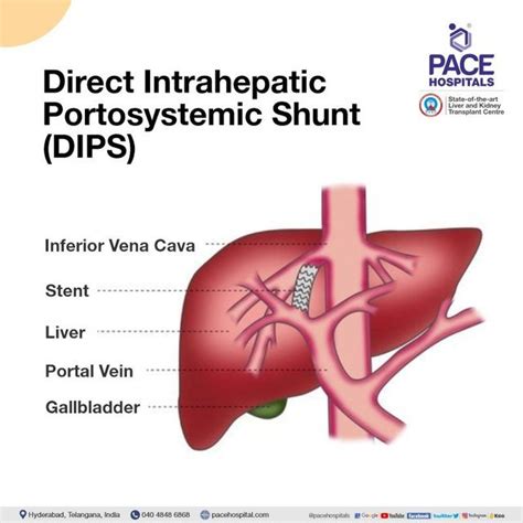 How Risky Is Liver Shunt Surgery: A Comprehensive Analysis