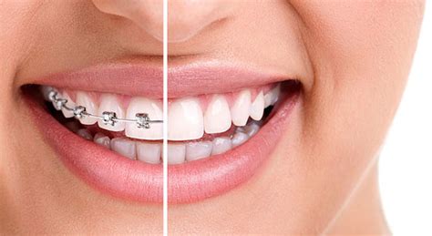 4 Easy Tips & Ways to Care for Your Dental Braces