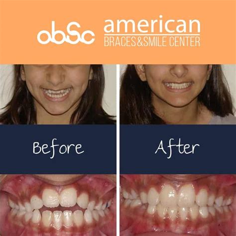 Buck Teeth Braces Before And After