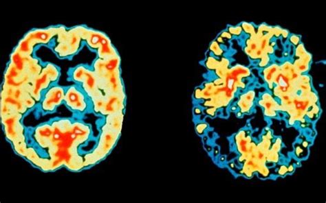 Brain scanning could improve dementia diagnosis for two thirds of patients, study finds