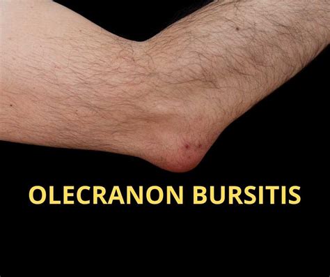 Olecranon Bursitis Elbow Bursitis | Images and Photos finder