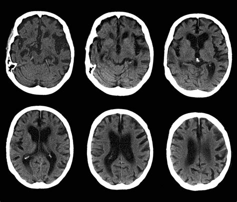 High Levels Of This Tap Water Element Could Help Prevent Dementia - CB Insights Research