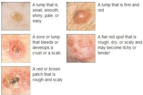 Skin Cancer On Face Early Signs