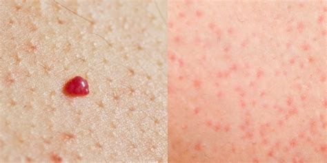 Blood Spots On Skin Red Tiny Raised Itchy Bumps Pictures Causes | Images and Photos finder