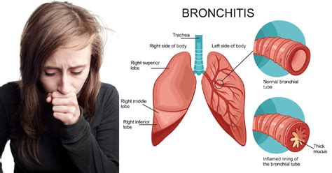 How Long Will Bronchitis Persist? | MedGuidance