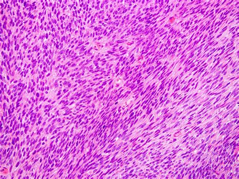 Synovial Sarcoma Histology