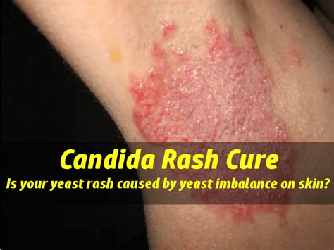 Candida rashes: is your yeast rash caused by yeast imbalance on skin?