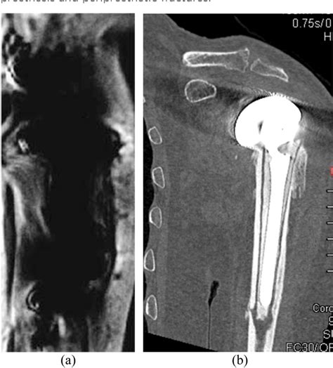 Figure 2 from Complications of rotator cuff surgery-the role of post-operative imaging in ...