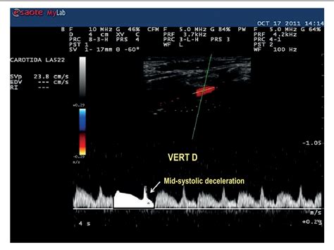 Figure 2 from An Update on Doppler Ultrasound of Vertebral Arteries: Subclavian Steal Syndrome ...