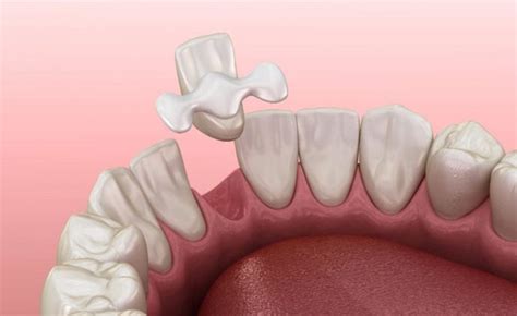 What Are Maryland Dental Bridge Pros and Cons? | CARDS DENTAL