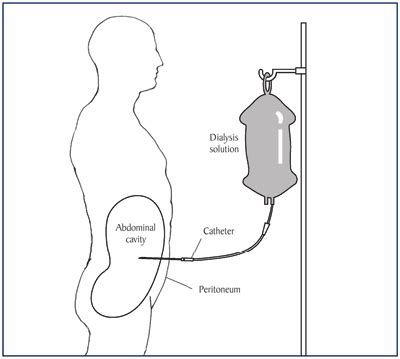 Peritoneal Dialysis Catheter Types