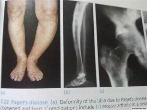 metabolic bone disease pptx - د. هشام - Muhadharaty