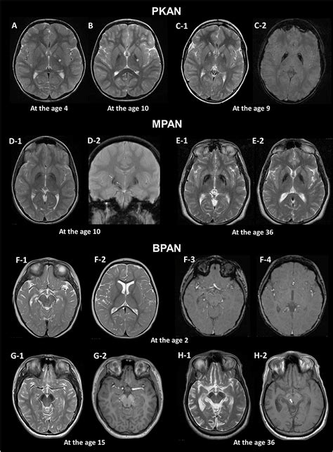 Brain Scan