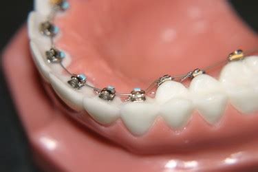 Lingual Braces | Orthodontics Reviews