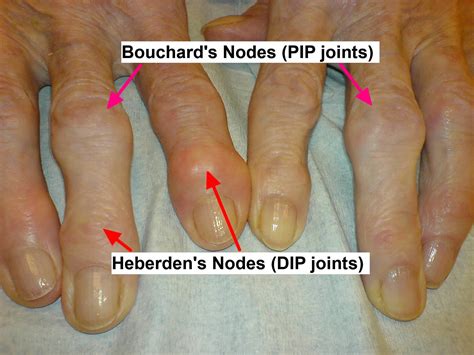 Osteoarthritis Stages