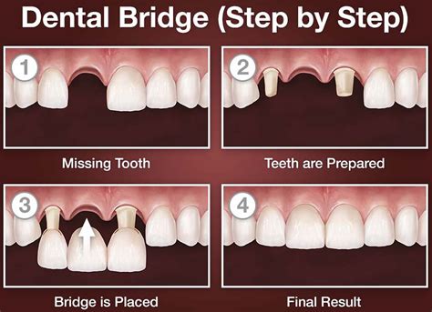 Dental Bridge - Procedure, Dental Bridge Vs Dental Implant